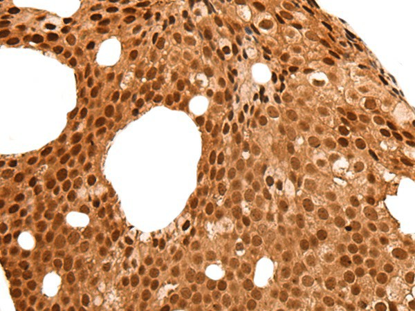 Immunohistochemistry of paraffin-embedded Human breast cancer tissue  using NEK7 Polyclonal Antibody at dilution of 1:60(?200)