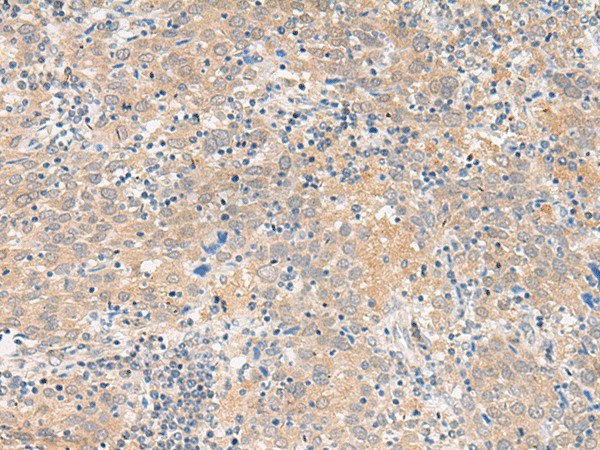 Immunohistochemistry of paraffin-embedded Human cervical cancer tissue  using GALP Polyclonal Antibody at dilution of 1:45(?200)