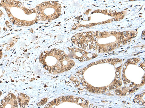 Immunohistochemistry of paraffin-embedded Human gastric cancer tissue  using SPCS2 Polyclonal Antibody at dilution of 1:40(?200)