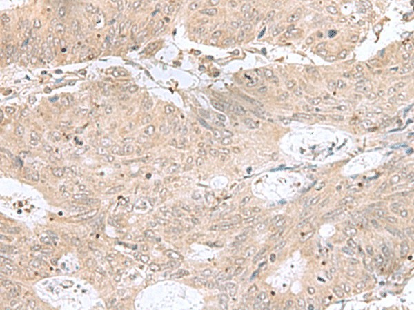 Immunohistochemistry of paraffin-embedded Human colorectal cancer tissue  using RPL35 Polyclonal Antibody at dilution of 1:50(?200)