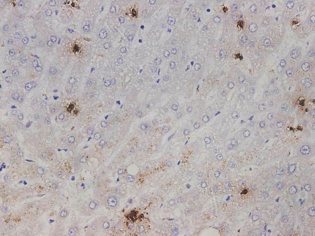 Immunohistochemistry of paraffin-embedded Human liver tissue using IL1A  Polyclonal Antibody at dilution of 1:2000(?400)