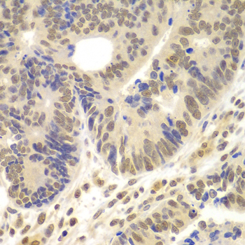 Immunohistochemistry of paraffin-embedded Human colon carcinoma using LHX4 Polyclonal Antibody at dilution of 1:100 (40x lens).