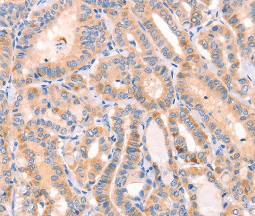 Immunohistochemistry of paraffin-embedded Human thyroid cancer tissue using CD109 Polyclonal Antibody at dilution 1:30