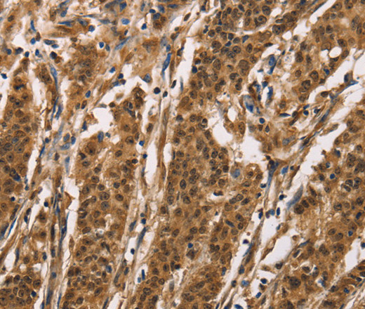 Immunohistochemistry of paraffin-embedded Human gasrtic cancer tissue using ADGRB1 Polyclonal Antibody at dilution 1:40