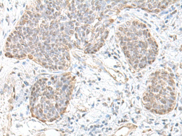 Immunohistochemistry of paraffin-embedded Human esophagus cancer tissue  using TCF25 Polyclonal Antibody at dilution of 1:35(?200)