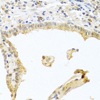 Immunohistochemistry of paraffin-embedded human lung cancer using PKC alpha Polyclonal Antibody at dilution of 1:100 (40x lens).Perform microwave antigen retrieval with 10 mM PBS buffer pH 7.2 before commencing with IHC staining protocol.