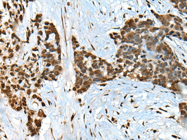 Immunohistochemistry of paraffin-embedded Human thyroid cancer tissue  using CCDC12 Polyclonal Antibody at dilution of 1:60(?200)