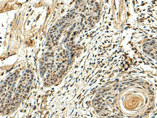 Immunohistochemistry of paraffin-embedded Human esophagus cancer tissue  using NUTF2 Polyclonal Antibody at dilution of 1:110(?200)