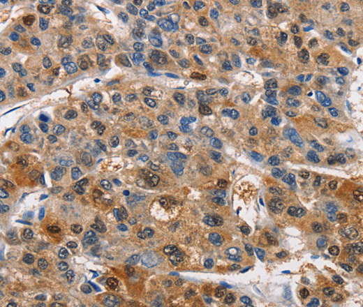 Immunohistochemistry of paraffin-embedded Human liver cancer tissue using PIM1 Polyclonal Antibody at dilution 1:40