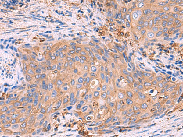 Immunohistochemistry of paraffin-embedded Human cervical cancer tissue  using G6PC Polyclonal Antibody at dilution of 1:70(?200)