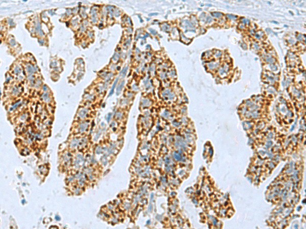 Immunohistochemistry of paraffin-embedded Human gastric cancer tissue  using PYCR2 Polyclonal Antibody at dilution of 1:35(?200)