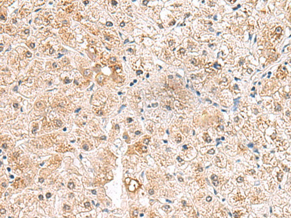 Immunohistochemistry of paraffin-embedded Human liver cancer tissue  using RTKN2 Polyclonal Antibody at dilution of 1:75(?200)