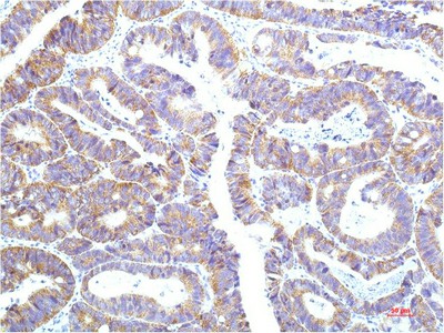 Immunohistochemistry of paraffin-embedded Human colon carcinoma tissue using STAT1 Monoclonal Antibody at dilution of 1:200.