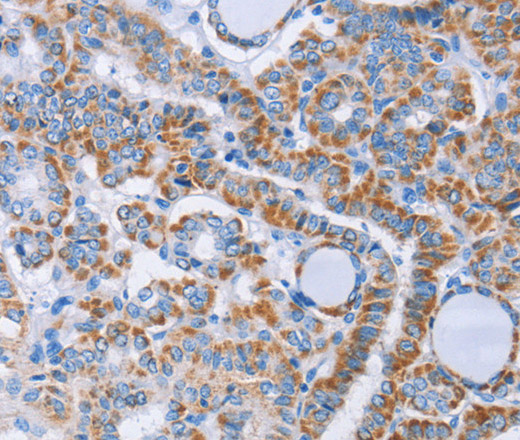 Immunohistochemistry of paraffin-embedded Human thyroid cancer using KIF3A Polyclonal Antibody at dilution of 1:40