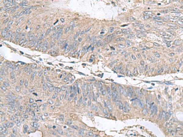 Immunohistochemistry of paraffin-embedded Human colorectal cancer tissue  using RNF208 Polyclonal Antibody at dilution of 1:55(?200)