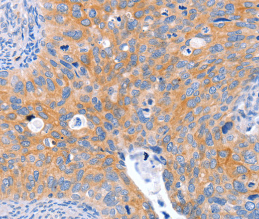 Immunohistochemistry of paraffin-embedded Human cervical cancer tissue using ABO Polyclonal Antibody at dilution 1:50