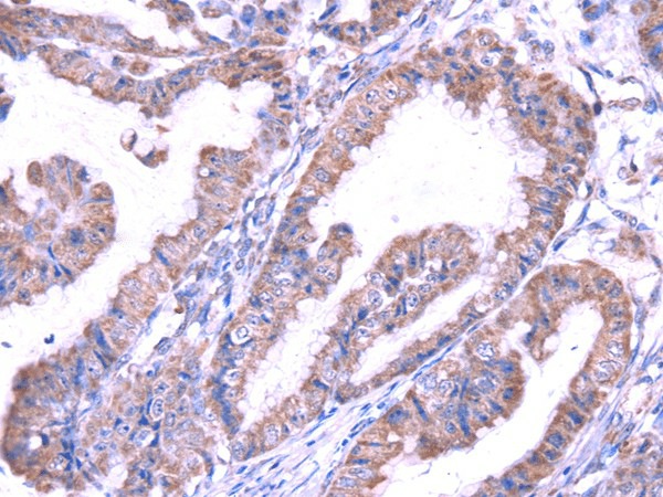 Immunohistochemistry of paraffin-embedded Human esophagus cancer using SRPK1 Polyclonal Antibody at dilution of 1/45