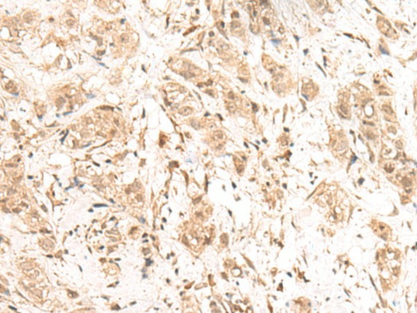 Immunohistochemistry of paraffin-embedded Human breast cancer tissue  using FIZ1 Polyclonal Antibody at dilution of 1:40(?200)