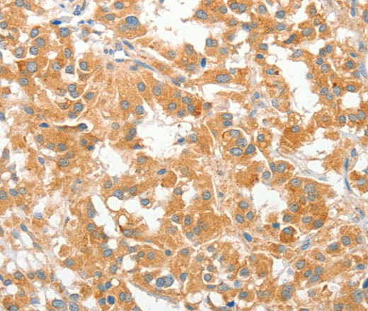 Immunohistochemistry of paraffin-embedded Human thyroid cancer using COL4A3BP Polyclonal Antibody at dilution of 1:60