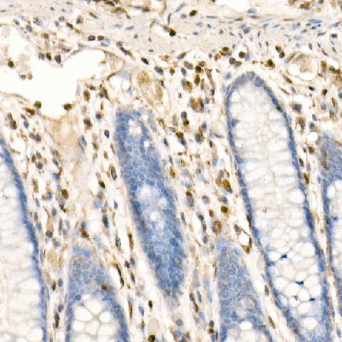 Immunohistochemistry of paraffin-embedded human colon using FSP1/S100A4 Polyclonal Antibody at dilution of 1:100 (40x lens).Perform high pressure antigen retrieval with 10 mM citrate buffer pH 6.0 before commencing with IHC staining protocol.