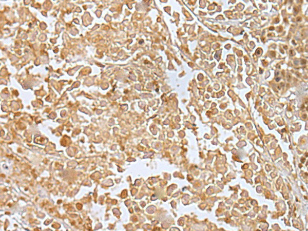 Immunohistochemistry of paraffin-embedded Human colorectal cancer tissue  using RILPL2 Polyclonal Antibody at dilution of 1:30(?200)