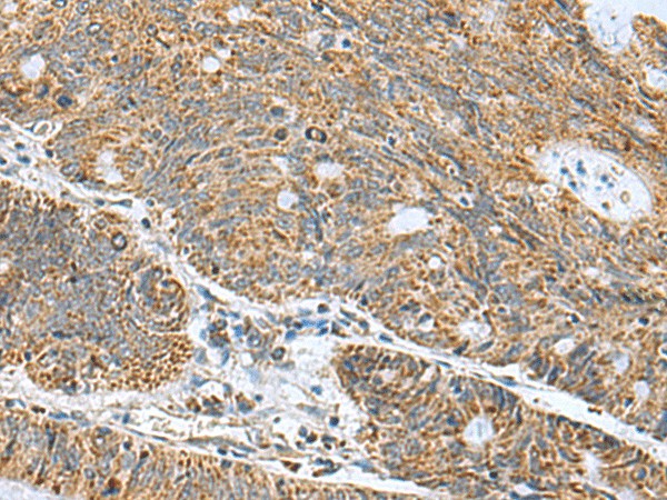 Immunohistochemistry of paraffin-embedded Human colorectal cancer tissue  using MRPL40 Polyclonal Antibody at dilution of 1:50(?200)