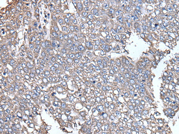 Immunohistochemistry of paraffin-embedded Human liver cancer tissue  using SCP2 Polyclonal Antibody at dilution of 1:35(?200)