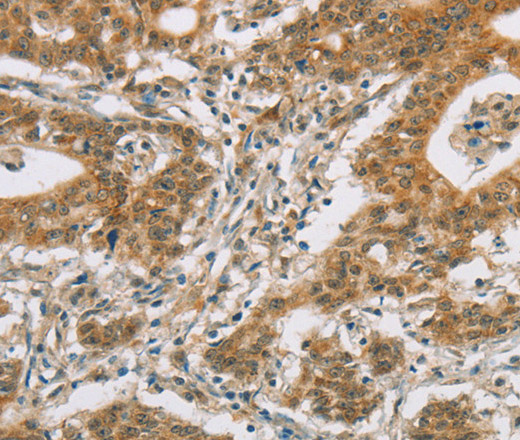 Immunohistochemistry of paraffin-embedded Human gastric cancer tissue using CYP11A1 Polyclonal Antibody at dilution 1:50