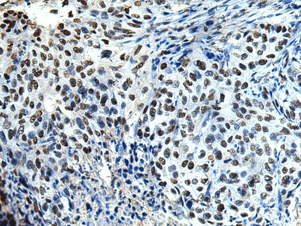 Immunohistochemistry of paraffin-embedded Human esophagus cancer tissue  using DDX39A Polyclonal Antibody at dilution of 1:65(?200)