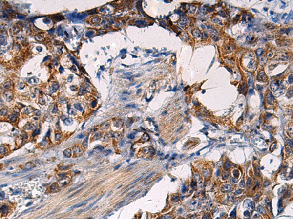 Immunohistochemistry of paraffin-embedded Human esophagus cancer tissue  using RITA1 Polyclonal Antibody at dilution of 1:50(?200)