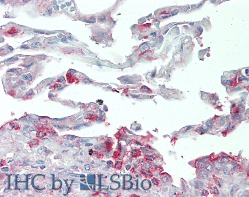 Immunohistochemistry of paraffin-embedded Human Lung tissue using SLC34A2 Polyclonal Antibody at dilution of 1:60(Elabscience Product Detected by Lifespan).