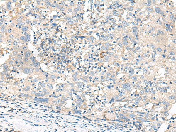 Immunohistochemistry of paraffin-embedded Human cervical cancer tissue  using GART Polyclonal Antibody at dilution of 1:30(?200)