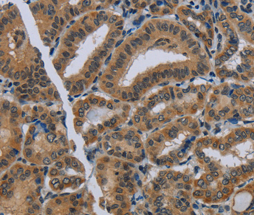 Immunohistochemistry of paraffin-embedded Human thyroid cancer using NAT10 Polyclonal Antibody at dilution of 1:40