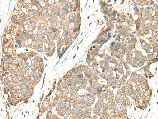 Immunohistochemistry of paraffin-embedded Human thyroid cancer tissue  using COA7 Polyclonal Antibody at dilution of 1:55(?200)