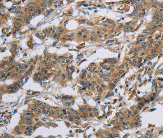 Immunohistochemistry of paraffin-embedded Human gastic cancer using SYN2 Polyclonal Antibody at dilution of 1:40