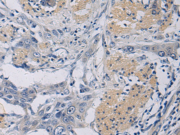 Immunohistochemistry of paraffin-embedded Human esophagus cancer tissue  using KLF1 Polyclonal Antibody at dilution of 1:35(?200)