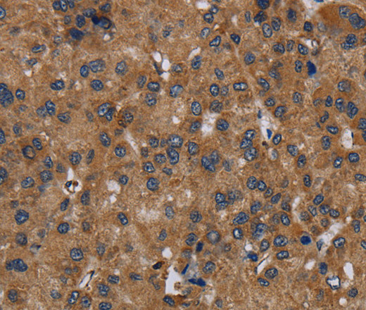 Immunohistochemistry of paraffin-embedded Human liver cancer using NDUFS8 Polyclonal Antibody at dilution of 1:50