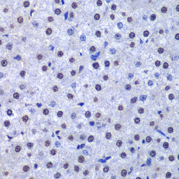 Immunohistochemistry of paraffin-embedded Human liver cancer using GSTP1 Polyclonal Antibody at dilution of 1:200 (40x lens).