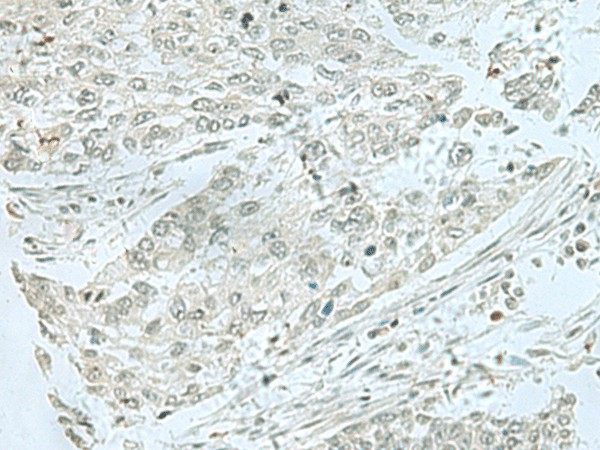 Immunohistochemistry of paraffin-embedded Human lung cancer tissue  using THTPA Polyclonal Antibody at dilution of 1:70(?200)