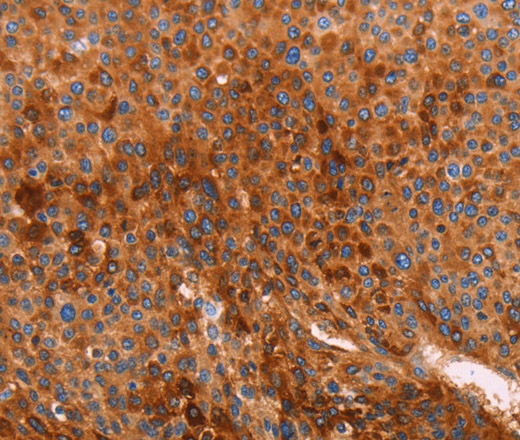 Immunohistochemistry of paraffin-embedded Human liver cancer using GC Polyclonal Antibody at dilution of 1:40