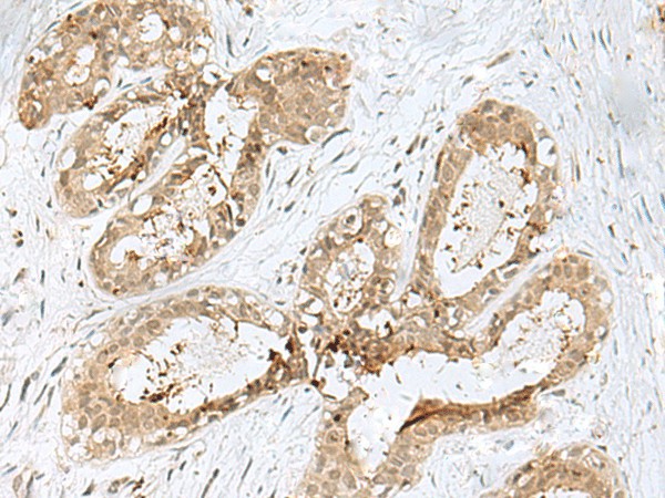 Immunohistochemistry of paraffin-embedded Human breast cancer tissue  using PSMA4 Polyclonal Antibody at dilution of 1:45(?200)