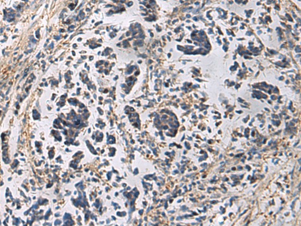 Immunohistochemistry of paraffin-embedded Human breast cancer tissue  using GRIK2 Polyclonal Antibody at dilution of 1:60(?200)