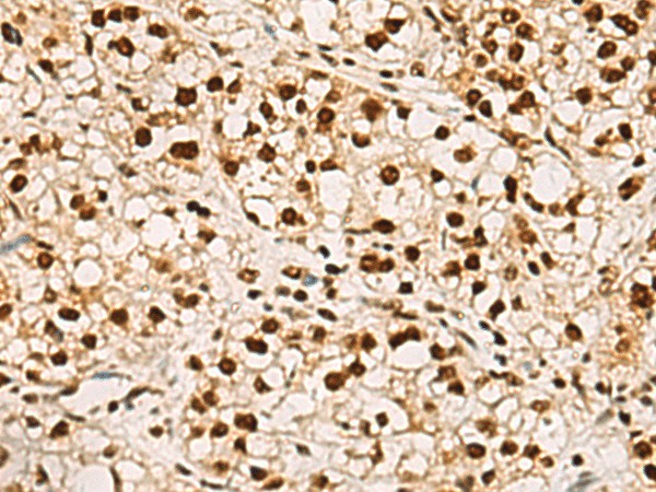 Immunohistochemistry of paraffin-embedded Human liver cancer tissue  using ELF5 Polyclonal Antibody at dilution of 1:75(?200)