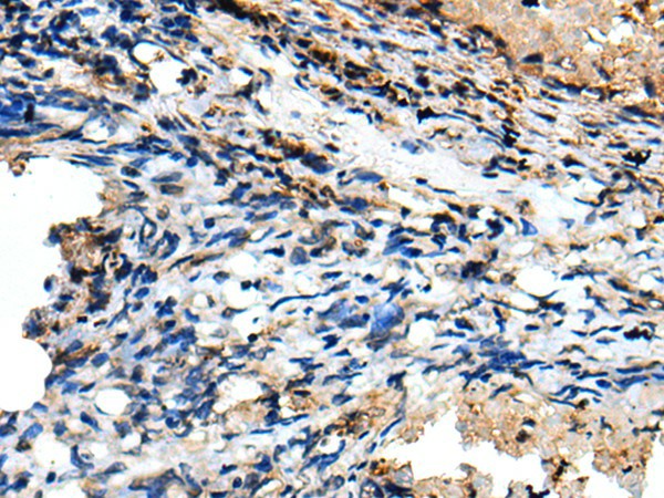 Immunohistochemistry of paraffin-embedded Human lung cancer tissue  using CSRP3 Polyclonal Antibody at dilution of 1:40(?200)