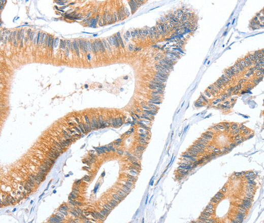 Immunohistochemistry of paraffin-embedded Human colon cancer using ACY3 Polyclonal Antibody at dilution of 1:35