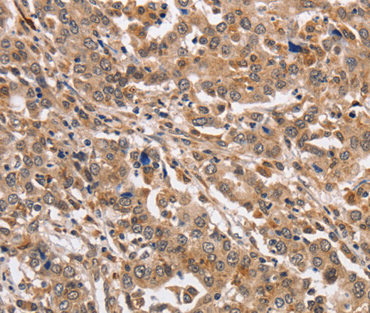 Immunohistochemistry of paraffin-embedded Human liver cancer using KCNG2 Polyclonal Antibody at dilution of 1:40