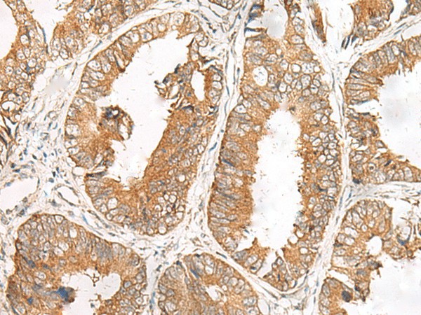 Immunohistochemistry of paraffin-embedded Human colorectal cancer tissue  using FERD3L Polyclonal Antibody at dilution of 1:85(?200)