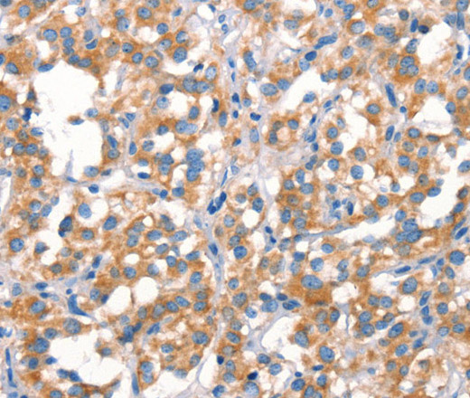 Immunohistochemistry of paraffin-embedded Human thyroid cancer tissue using Cytochrome b Polyclonal Antibody at dilution 1:30