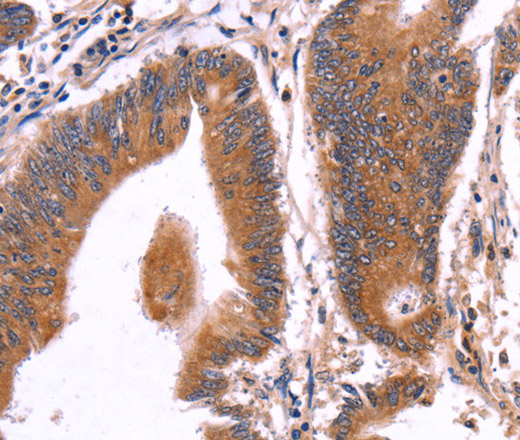 Immunohistochemistry of paraffin-embedded Human colon cancer tissue using CRISP3 Polyclonal Antibody at dilution 1:50