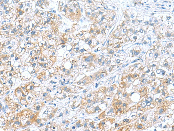 Immunohistochemistry of paraffin-embedded Human liver cancer tissue  using DNAL1 Polyclonal Antibody at dilution of 1:70(?200)